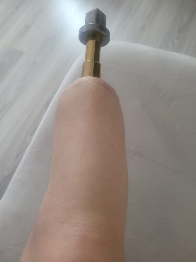 Pielęgnacja stomii BADAL X